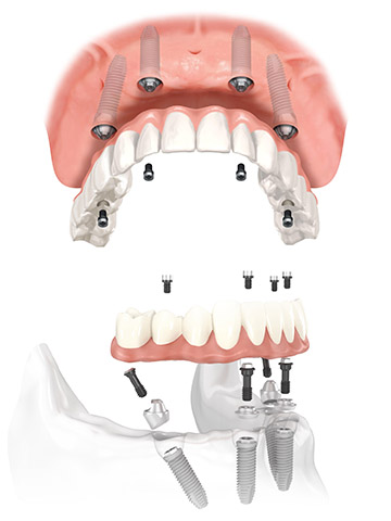 upper lower all on 4 illustration